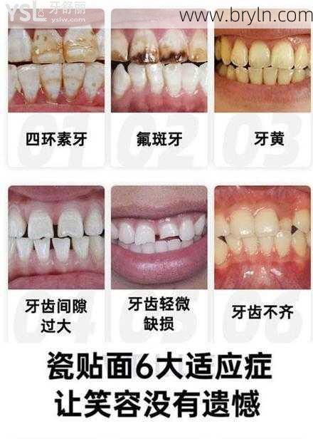 牙贴片(科普牙齿贴片究竟需不需要磨牙,不磨牙的瓷贴面靠谱吗?)
