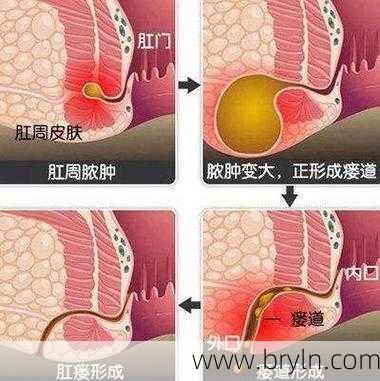 什么叫肛瘘(肛瘘是什么?有这5个异常的人,很可能已经“中奖”了)