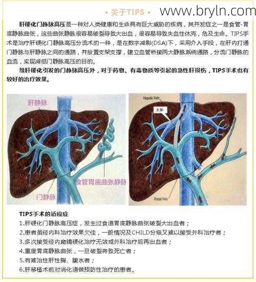 tips手术(TIPS手术:为门静脉高压患者打通“生命通道”)