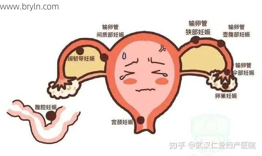 宫外孕是什么症状(【科普】宫外孕很危险,关于宫外孕的7个常识一定要清楚!)