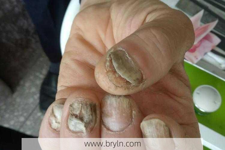 灰指甲会自愈吗(皮肤科医生:灰指甲不能自愈,心存侥幸没有意义)