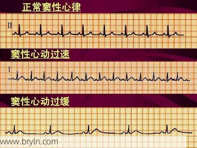 什么是心律不齐(心律不齐是什么意思?做好3个措施,下回体检没毛病)