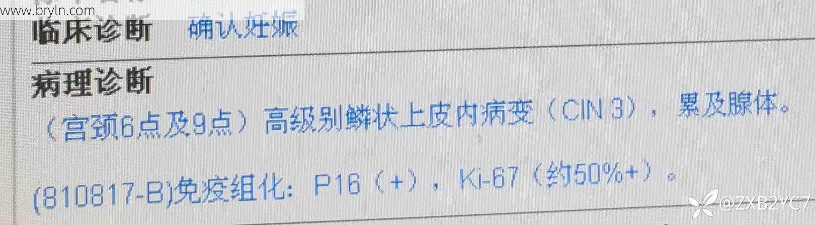 低度鳞状病变(宫颈鳞状上皮低级别上皮内病变(LSIL),不应该过度治疗)