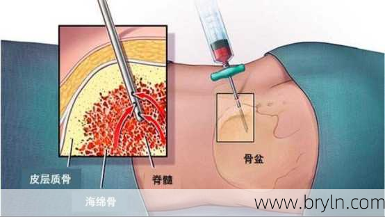 骨穿刺(「技术」骨髓穿刺术)