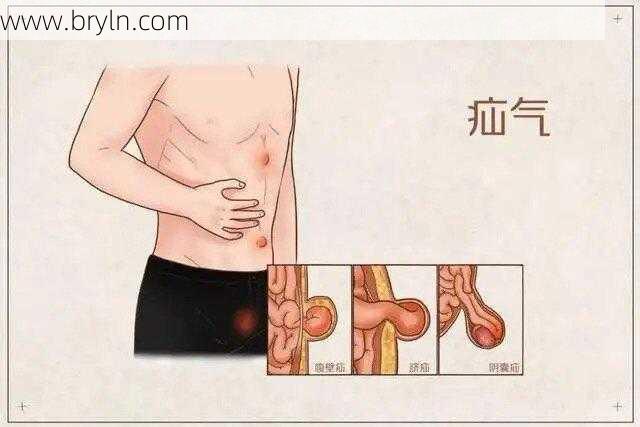 疝气是怎么引起的呢？女孩子也会得疝气吗？这可不会和你“客气”