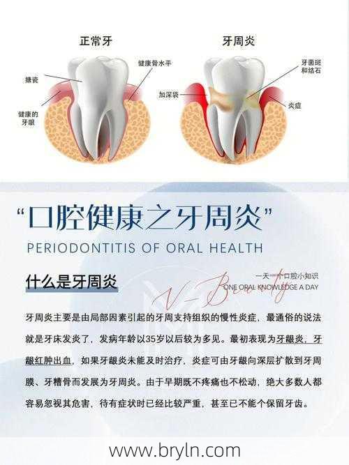 牙周炎会传染吗？注意这4件事，离牙周炎再远一点