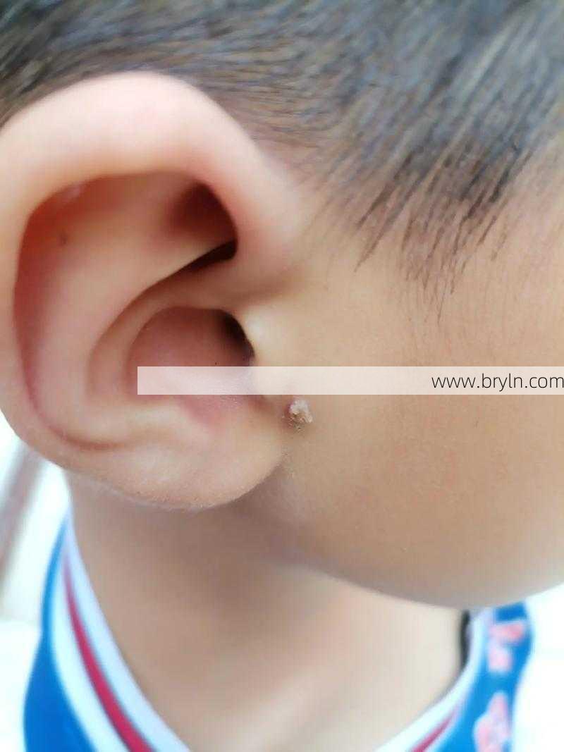 瘊子怎么去掉()