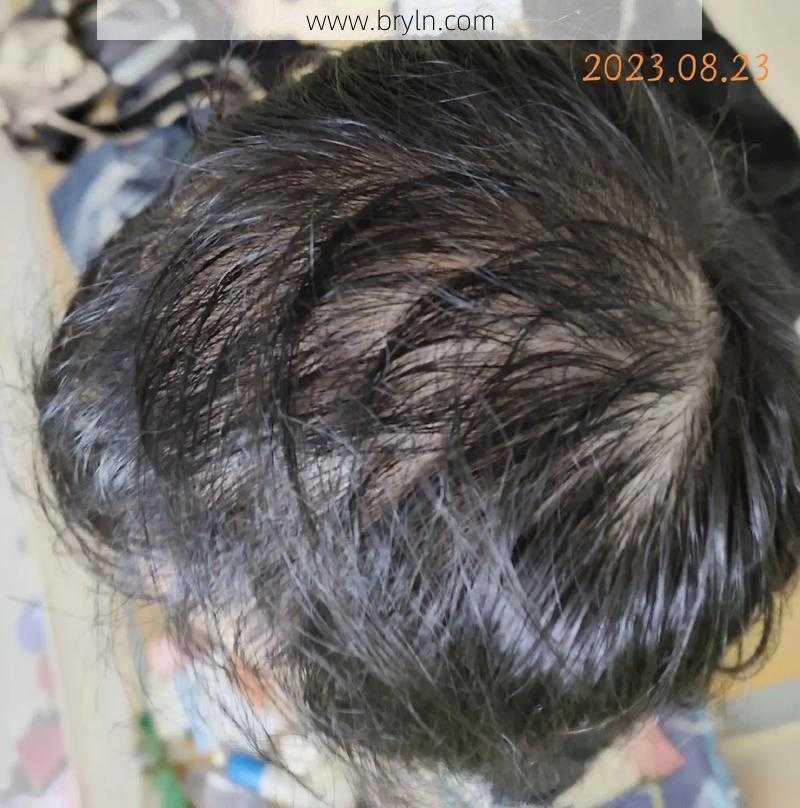 鬼剃头怎么治()