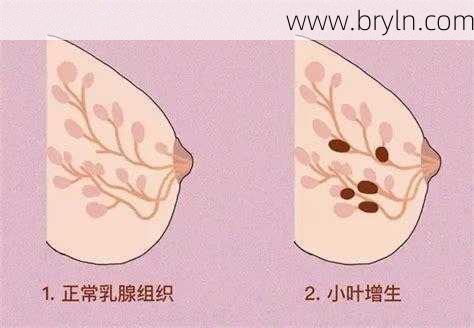 双侧乳腺小叶增生()
