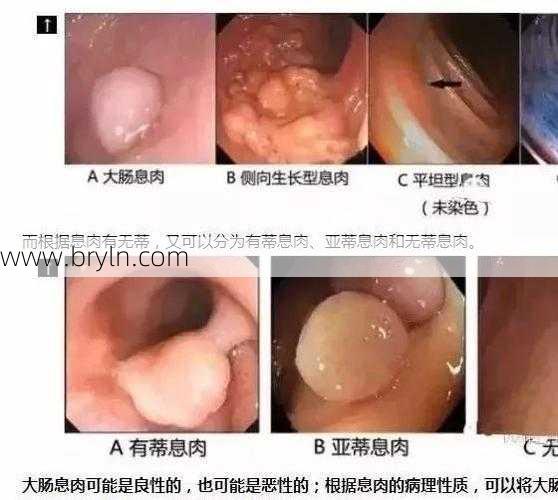 息肉是什么东西(息肉是什么？息肉是癌前病变吗？#医学科普)