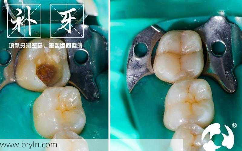 补牙挂什么科(补牙前必看丨补牙常见4连问，牙科医生一次性给你讲清楚)