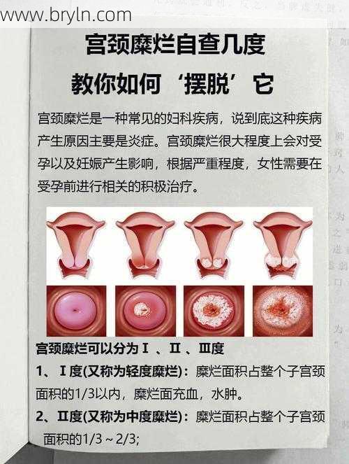子宫糜烂怎么治疗()
