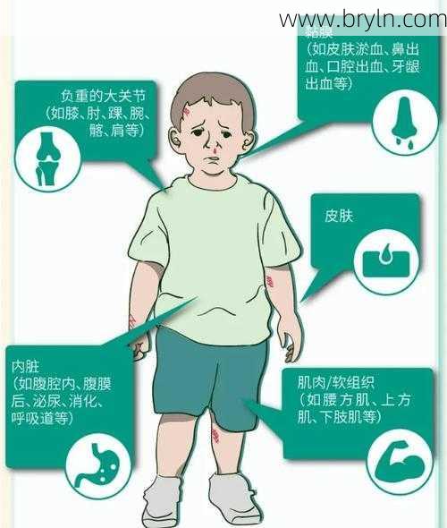 血友病是什么病?患血友病的孩子有哪些临床表现?