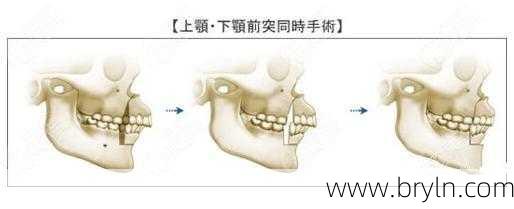 正颚手术(关于正颌手术,你需要了解的事)