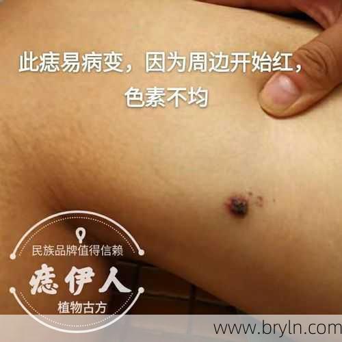 已确诊！癌症晚期！只因身上一颗痣……