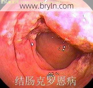 克罗恩病能活多久()