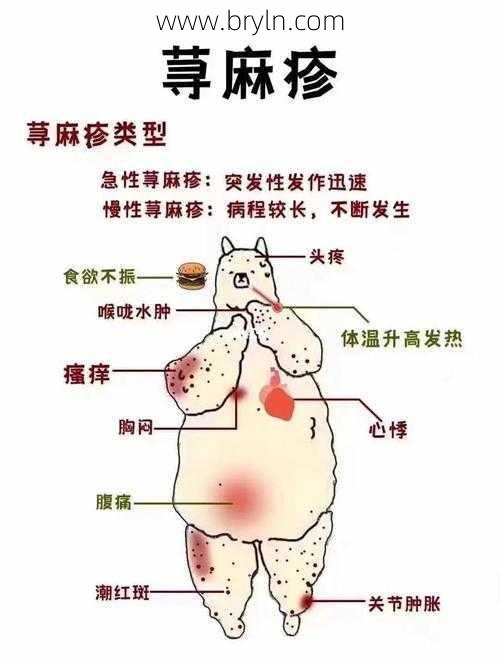 荨麻疹会传染吗 这些都是荨麻疹的症状