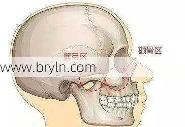 颧骨是哪个部位(是颧骨?还是苹果肌?高颧骨只能通过手术解决吗?)