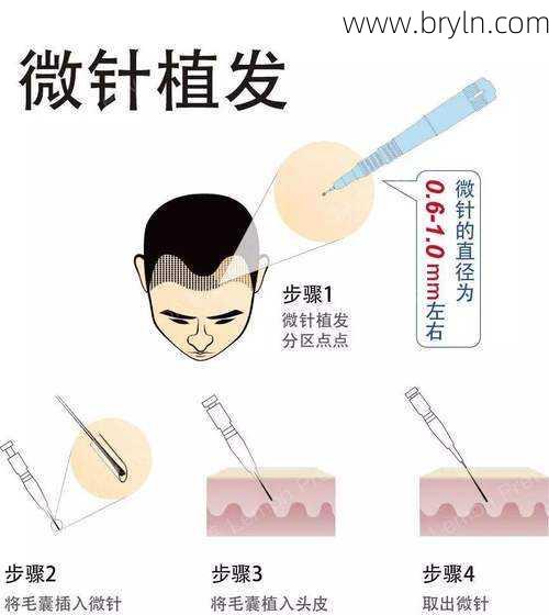 不打价格战的科发源,靠“微针植发”实现高速成长