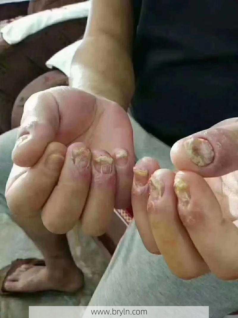 灰指甲好治吗