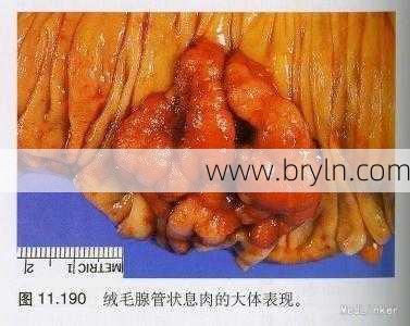 直肠腺瘤严重吗(直肠管状腺瘤严重吗?)