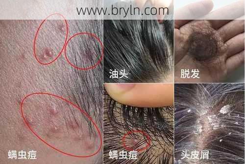 螨虫感染(痒到让人头皮发麻的疥螨,到底是啥?是怎么被感染上的?)