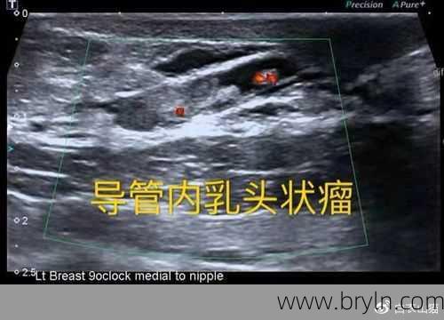 乳腺导管内乳头状瘤,该如何诊治?
