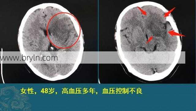 “脑缺血灶”=脑梗吗?