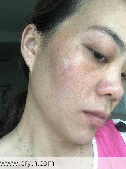 女人脸上黄褐斑(36岁满脸黄褐斑,老中医一个活血祛斑方,让女人面若桃花)