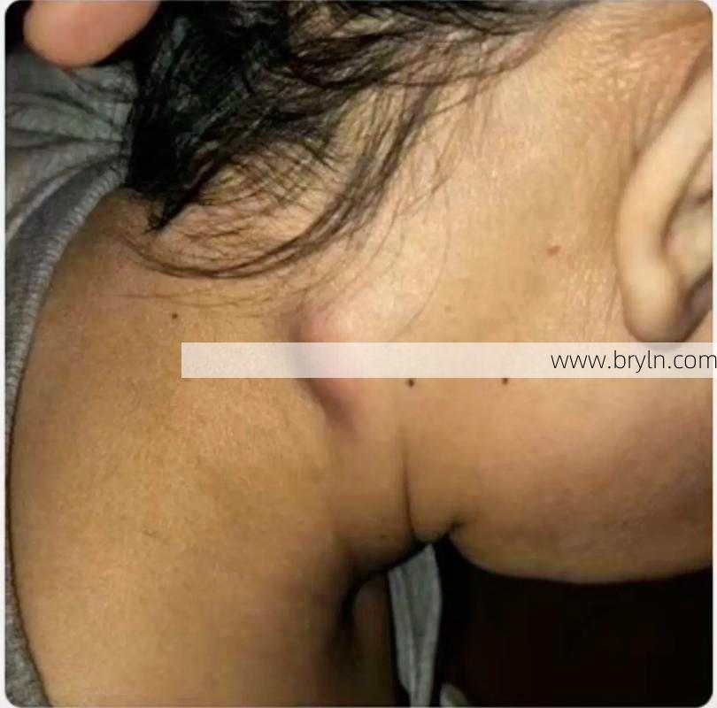 淋巴结核传染吗(淋巴结核作为一种结核性疾病,会传染吗?)