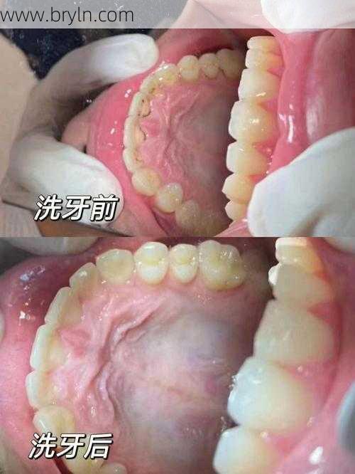 洗牙能把牙洗白吗(洗牙到底能不能给牙齿洗白白?)