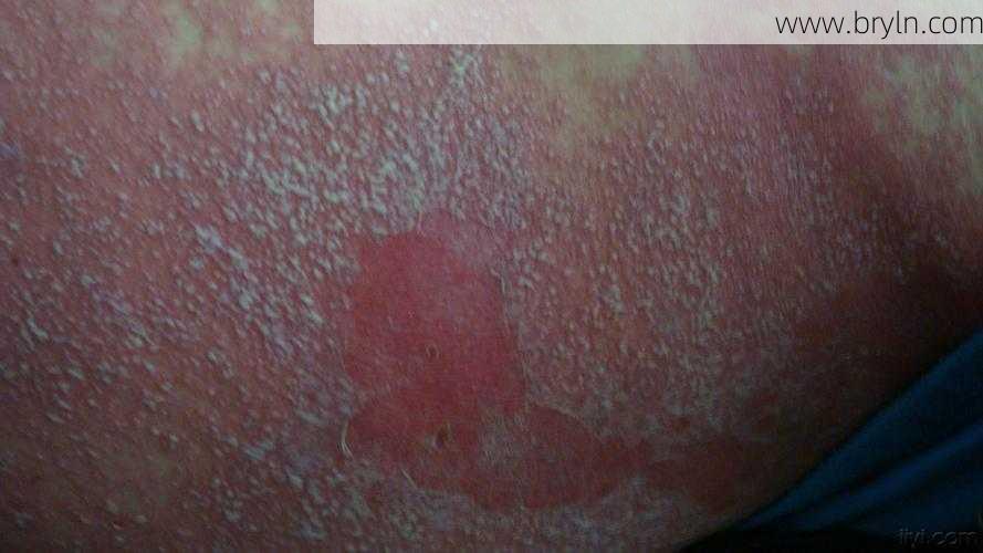 腹股沟瘙痒(腹股沟区出现红斑,持续瘙痒!这种真菌感染实在太尴尬)