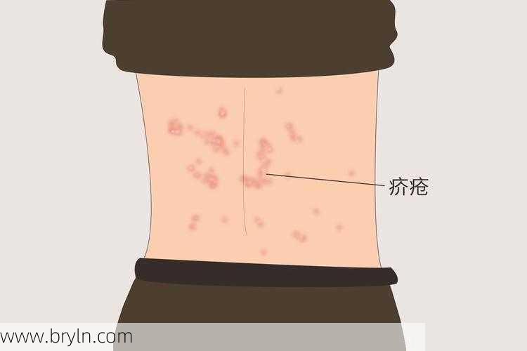 疥疮症状(红疹、瘙痒痛苦难耐,避免熬夜、勤晒被褥,让你远离“疥疮”尴尬)
