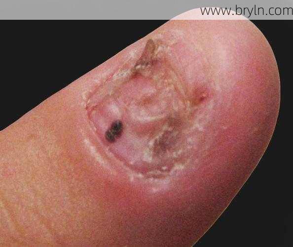 蛔虫病症状(肚子疼、磨牙、咬指甲,是不是有蛔虫了?)