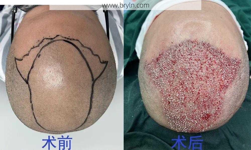 毛发种植有哪些()
