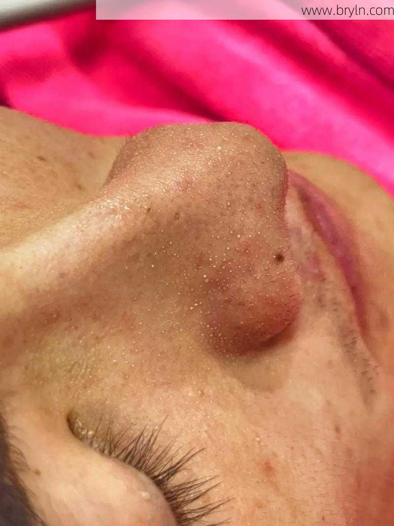 清洁毛孔()