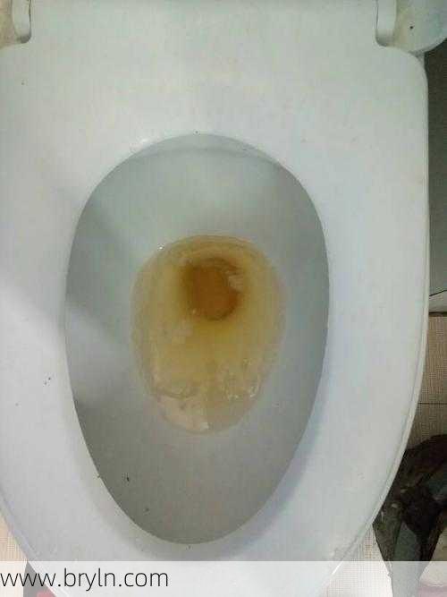 尿液很黄怎么回事(尿尿时,发现尿液很黄是怎么回事?有这7种可能性)