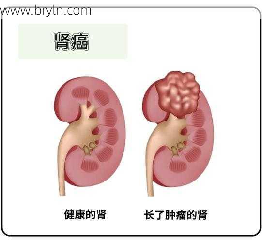 肾癌晚期(得了晚期肾癌可以活多久？肾癌好治么？真相来了)