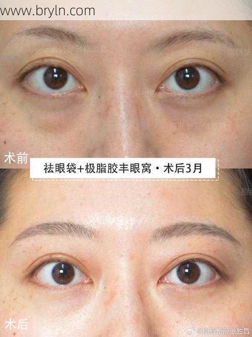 做眼袋手术多少钱(去眼袋手术多少钱 去眼袋误区有哪些)