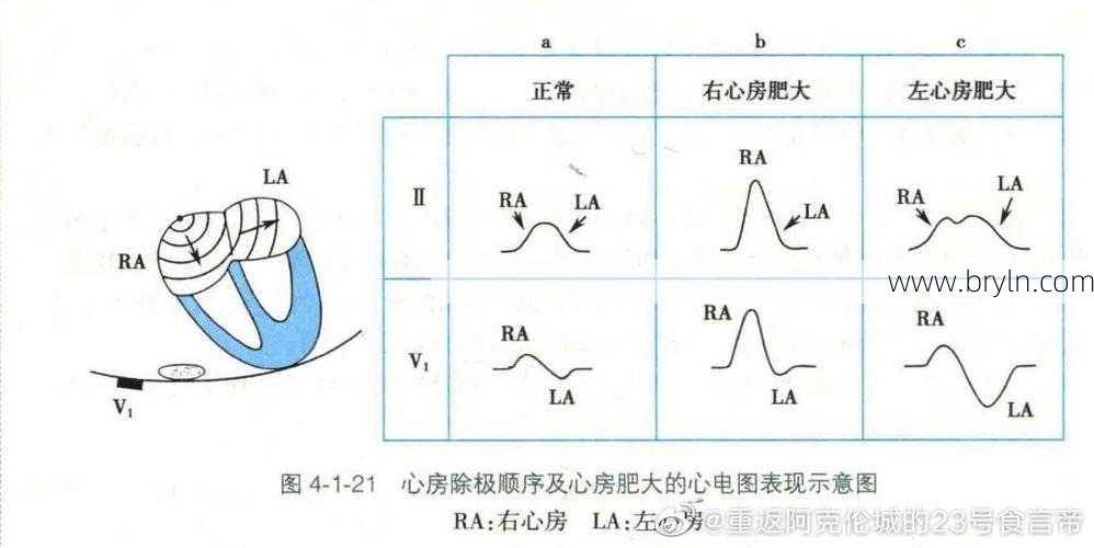p波增宽什么意思(交替变化的P波，揭露房间传导的秘密｜识“图”寻踪)