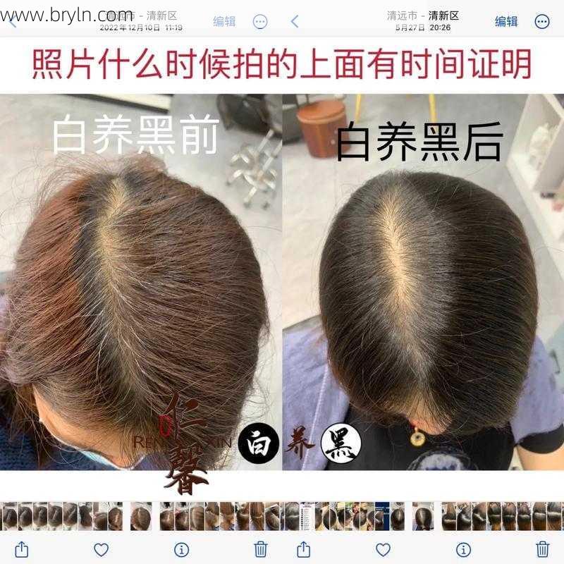 年纪轻轻却长了白头发？不要慌4招让你白发变黑发