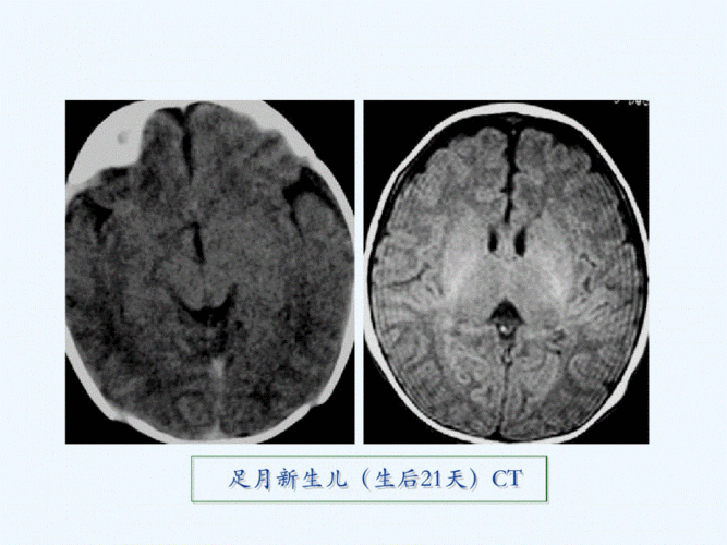 新生儿缺氧缺血性脑病（HIE）的CT诊断