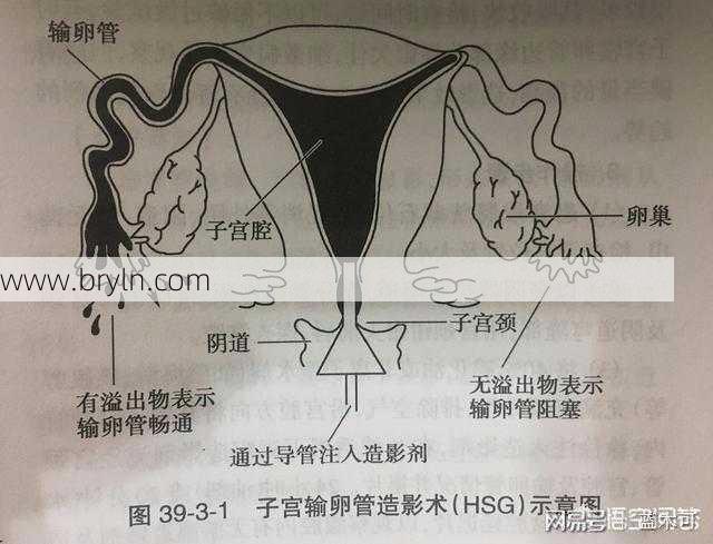 输卵管造影副作用(输卵管造影检查有什么风险？这4个副作用，女性要知道)