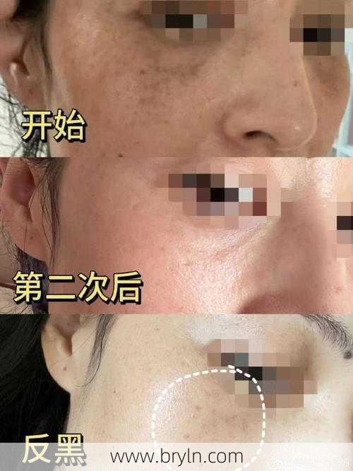 激光祛斑疼不疼(什么是调Q激光，调Q激光祛斑疼吗，祛斑效果如何)
