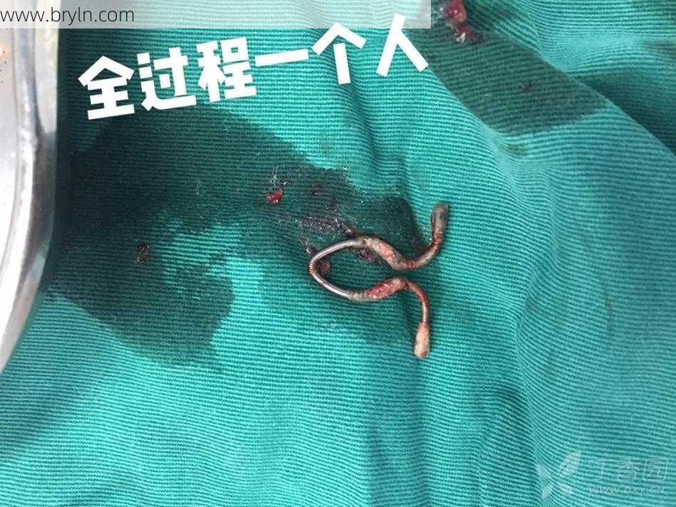取环痛不痛()