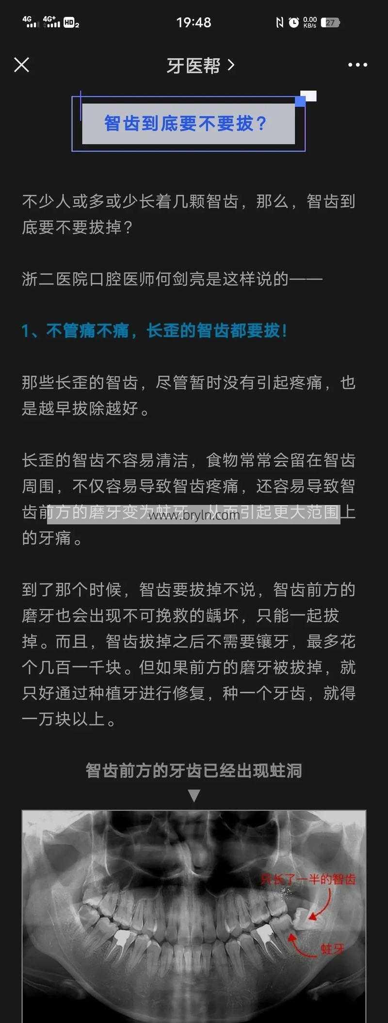 长智齿一般疼几天(「知识问答」拔智齿有多疼？拔完智齿疼一般要疼几天？)