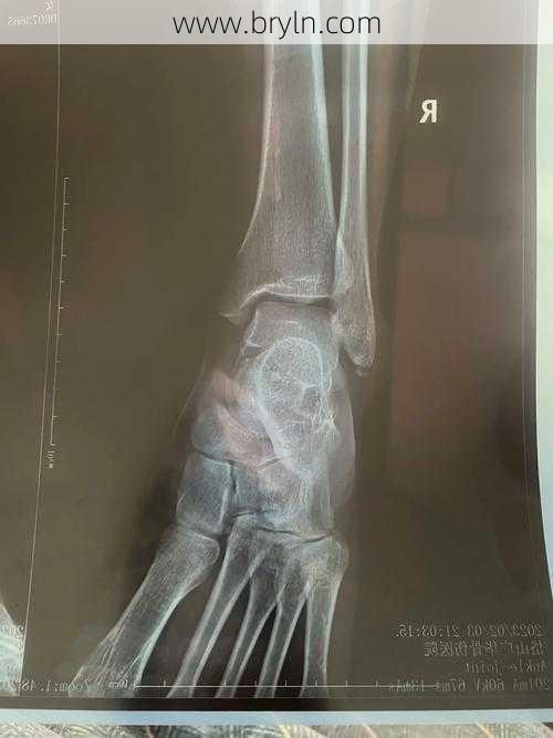 骨折后遗症是什么意思？如何治疗骨折后遗症？