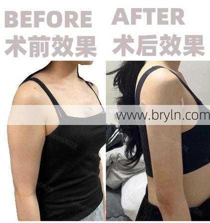 手臂吸脂有什么副作用吗？威塑吸脂的效果怎么样