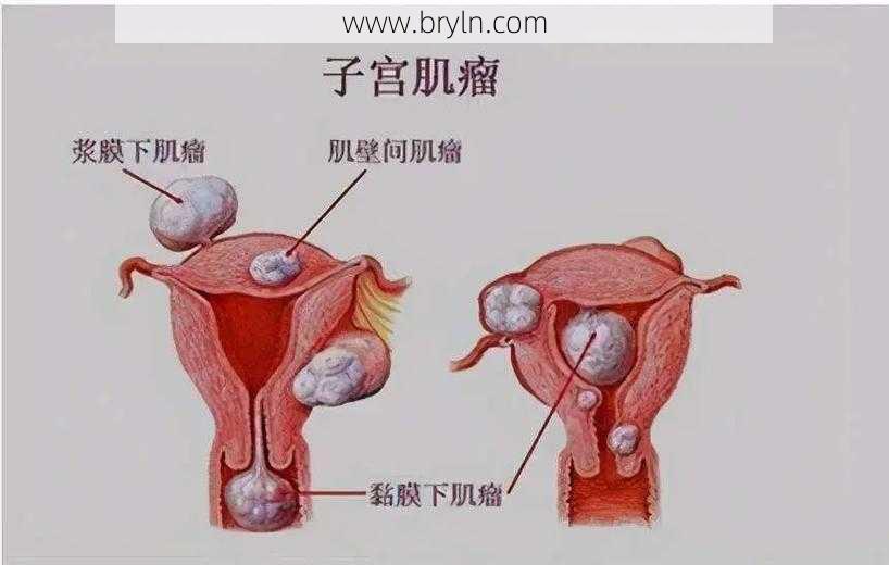 子宫腺肌瘤是什么病？