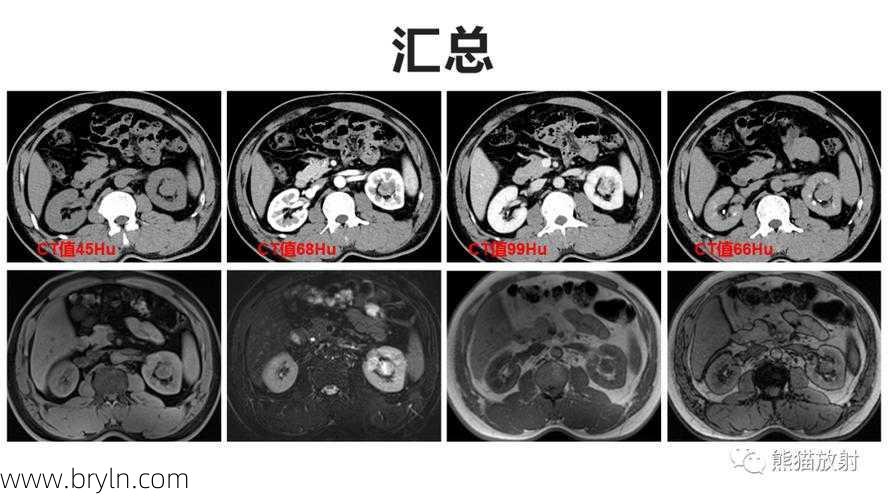 9种肾窦病变，看看看完能掌握几个
